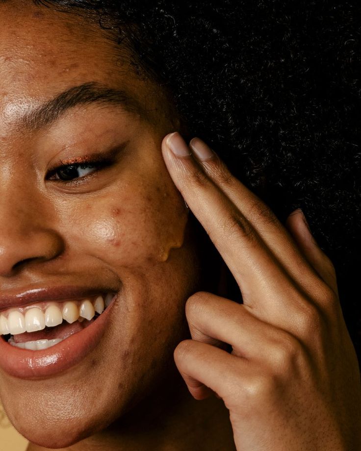 Why Dark Spots Appear After Breakouts and How to Treat Them